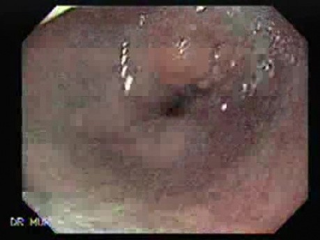 Distal Esophageal Squamous Cell Carcinoma - Endoscopic View