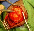 Epicranial Tumor Injury