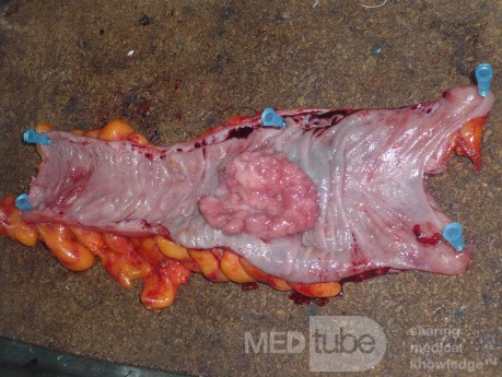 Colon Adenocarcinoma, Villous Adenocarcinoma (7 of 12)