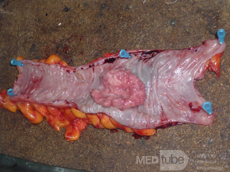 Colon Adenocarcinoma, Villous Adenocarcinoma (7 of 12)