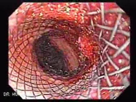 Placement Of The Esophageal Stent - 9/12