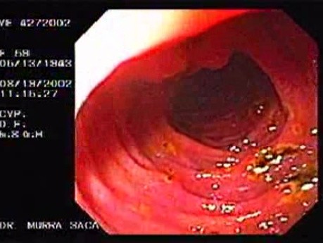 Multiple Duodenal Ulcers (3 of 3)