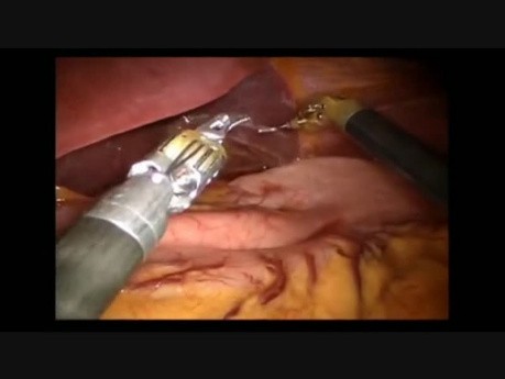 Nissen Fundoplication