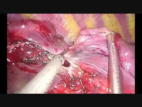 Subxiphoid Uniportal Middle Lobectomy and Anatomic Anterior Segmentectomy (S3)