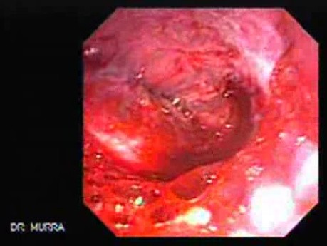 Upper Gastrointestinal Bleeding - Site of the Bleeding