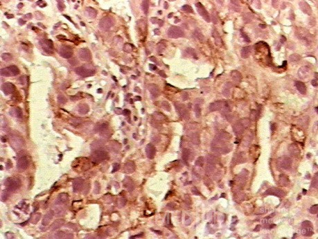 Barrett Adenocarcinoma - Endoscopic Image (9 of 20)