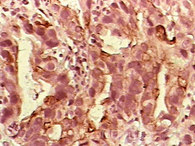 Barrett Adenocarcinoma - Endoscopic Image (9 of 20)