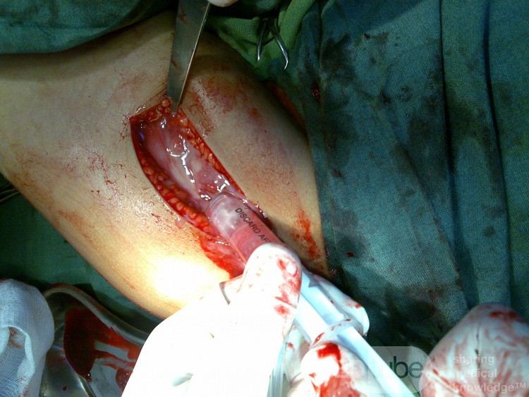 Acute Osteomyelitis of femur
