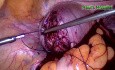 Laparoscopic Excision of Leiomyomas