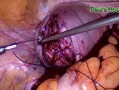 Laparoscopic Excision of Leiomyomas