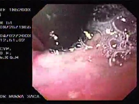 Banding of esophageal varices (16 of 17)