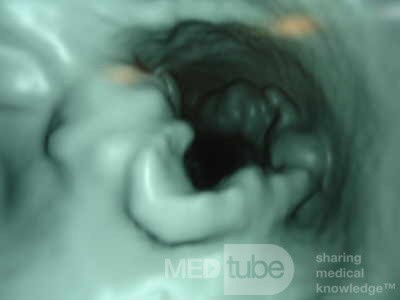 Adenocarcinoma of the Transverse Colon (4 of 15)