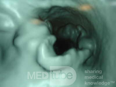Adenocarcinoma of the Transverse Colon (4 of 15)