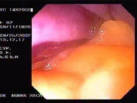 Colon Sigmoid Perforation (4 of 4)