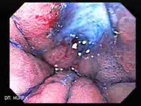 Hourglass Stomach - Chromoendoscopy, Part 2