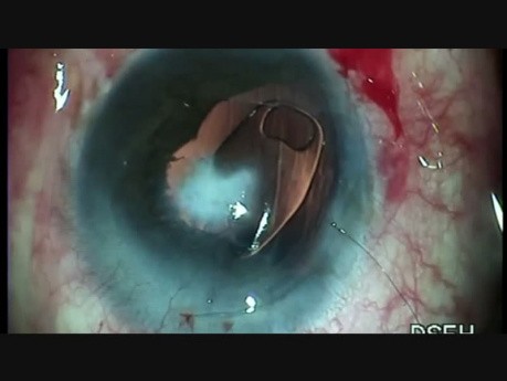 Adherent Leucoma, Black Cataract, Iris Claw Lens Implantation