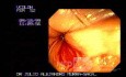 Anal Fissure