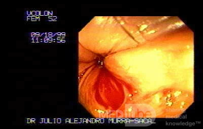 Anal Fissure