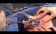 Transanal Minimally Invasive Surgery - Modification