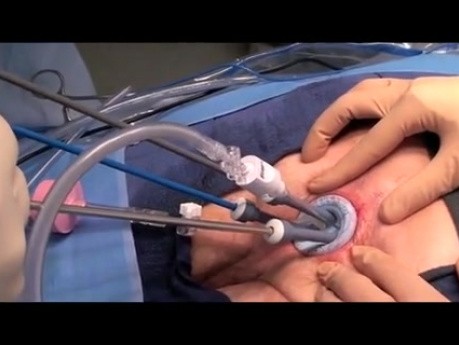 Transanal Minimally Invasive Surgery - Modification