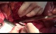 Surgery for retroperitoneal tumor with left nephrectomy
