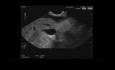 Endoscopic Ultrasound of Common Bile Duct Stricture