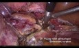 Total Hysterectomy for Resident (Fully Narrated Video)