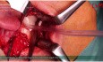 Osteosynthesis of the Base of the Mandibular Condyle, 3AXP Plate