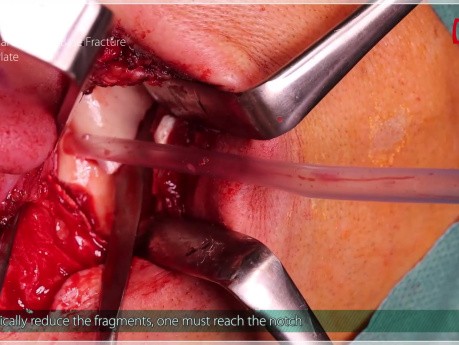 Osteosynthesis of the Base of the Mandibular Condyle, 3AXP Plate