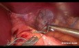 Toupet Fundoplication