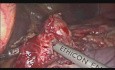 Laparoscopic Total Gastrectomy with Esophagojejunostomy using OrVil