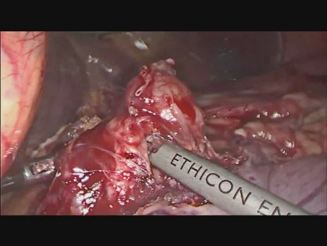 Laparoscopic Total Gastrectomy with Esophagojejunostomy using OrVil