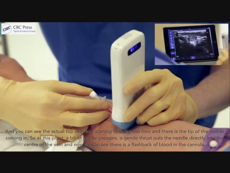 Venous Access Made Easy - Trailer