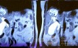 Liver Hydatid Cyst Profection to CBD and Cholangitis and Extraction of Doughter Cyst with ERCP