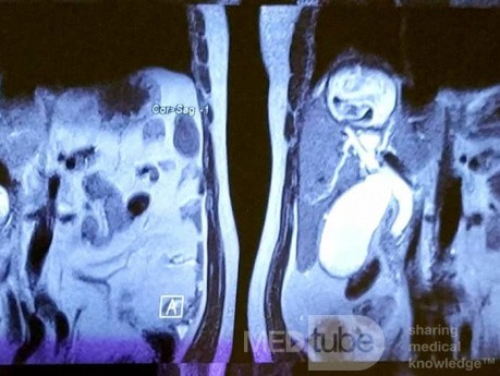 Liver Hydatid Cyst Profection to CBD and Cholangitis and Extraction of Doughter Cyst with ERCP
