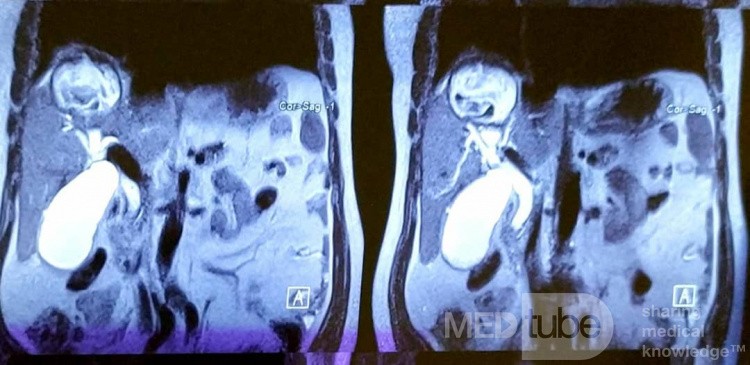 Liver Hydatid Cyst Profection to CBD and Cholangitis and Extraction of Doughter Cyst with ERCP