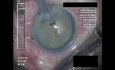 Cataract Surgery VIII - Part 1