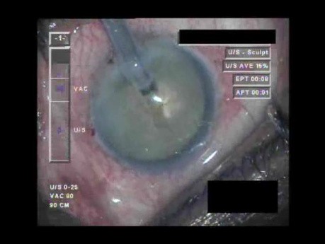 Cataract Surgery VIII - Part 1