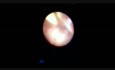 Ureteroscopy for Upper Big Ureteric Stone