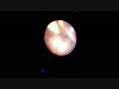 Ureteroscopy for Upper Big Ureteric Stone