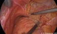 Cas Chirurgical d'une Sténose Urétérale Gauche Etendue