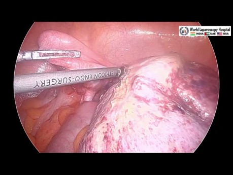 Laparoscopic Oophorectomy for Ovarian Torsion