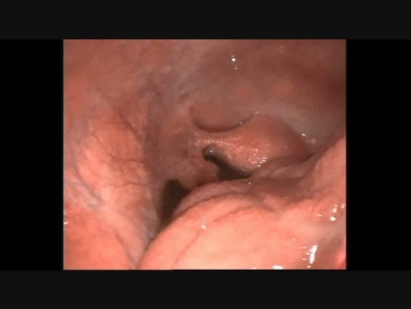 LAP Intraperituneal TB
