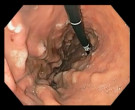 Ménétrier Disease - Practical Approach