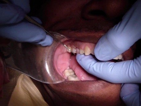 Empress CAD Crown Before Cementation