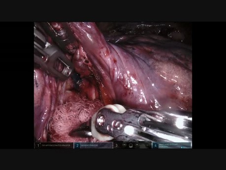 Inferior Lobectomy - Adhesions