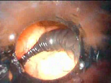 Gastrointestinal Stromal Tumor - GIST (34 of 65)