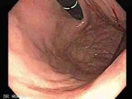 Bleeding Due to Dieulafoy´s Lesion (3 of 7)
