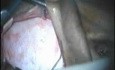 Cholesteatoma - Canal Up Mastoidectomy Incision - Part 1