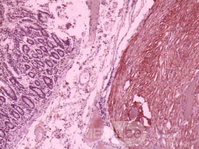 Jejunal Gastrointestinal Stromal tumor (GIST) (13 of 86)
